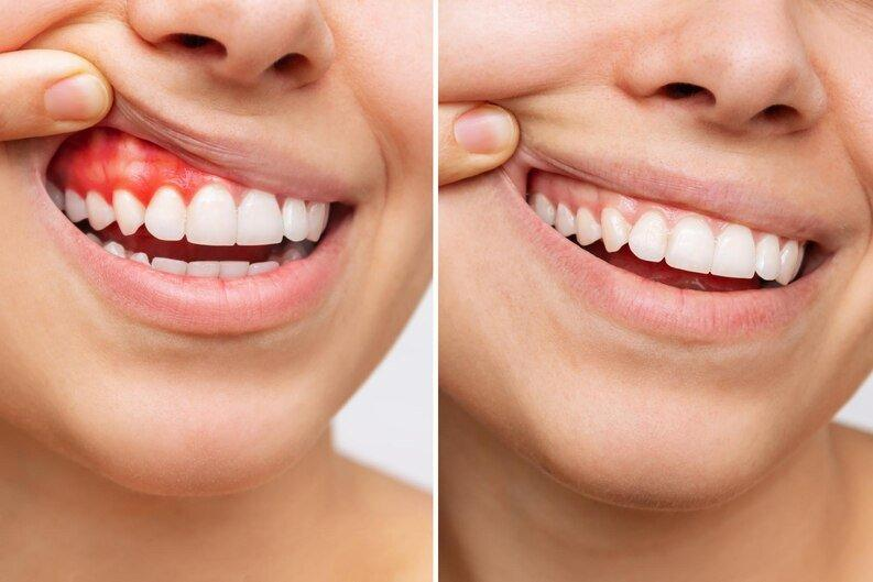 Gum Depigmentation