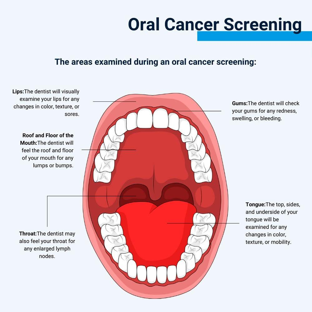 Oral Cancer