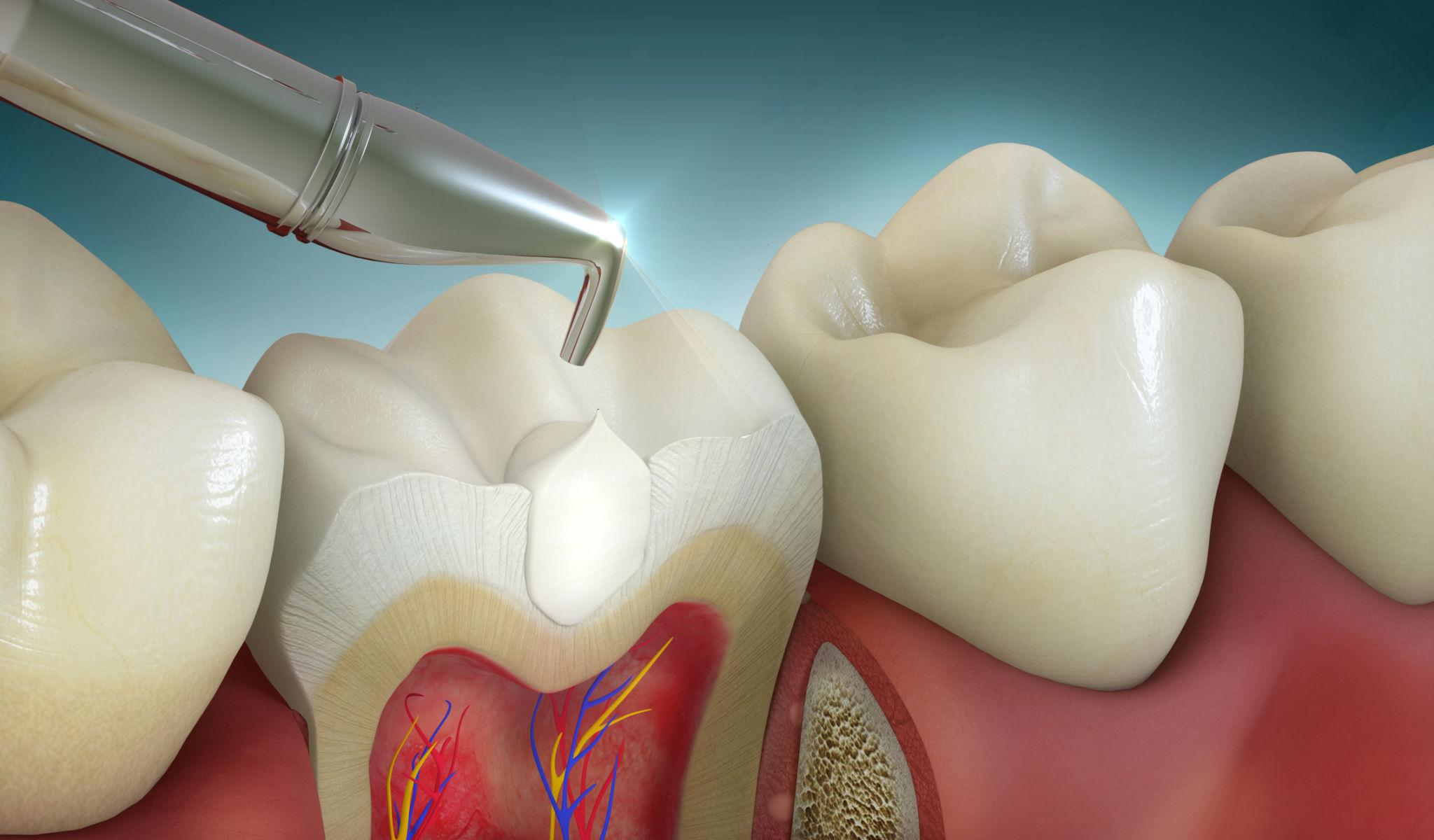 Tooth coloured Filling