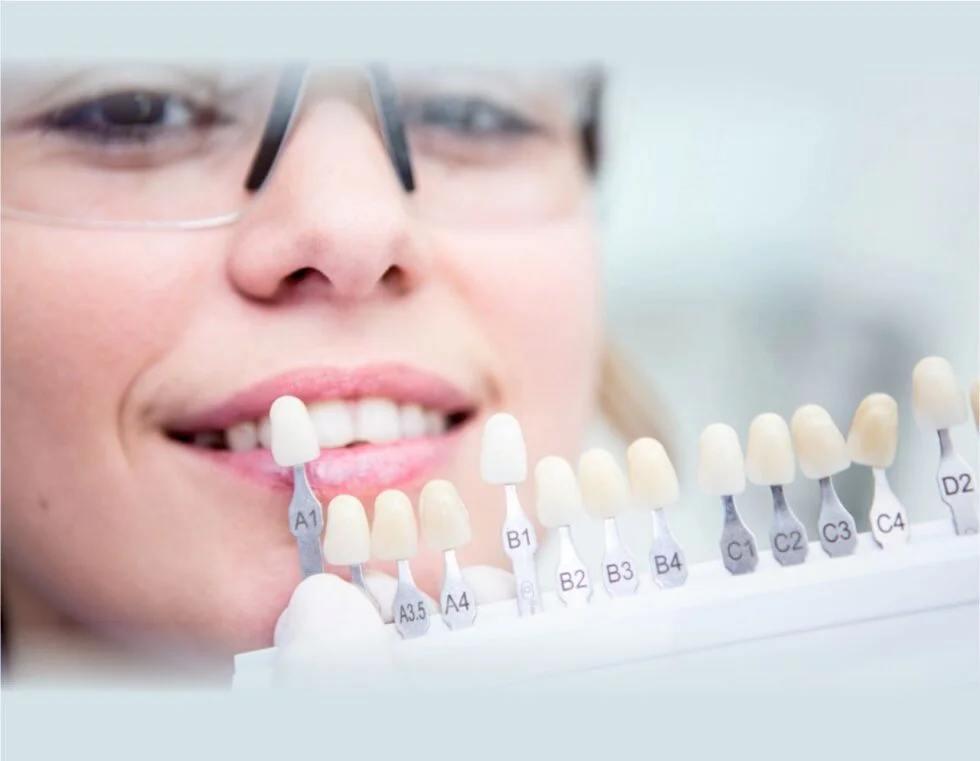 Tooth coloured Filling