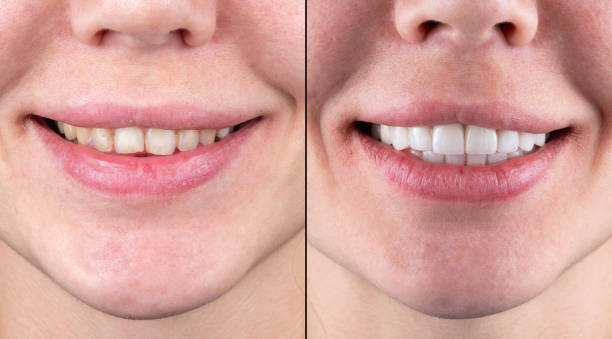 Veneers